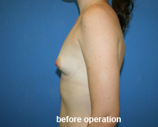 plastic-surgery-breast-augmentation